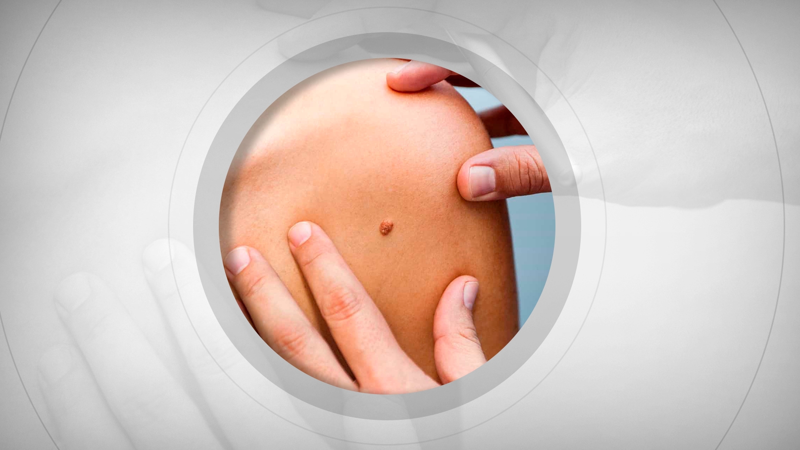 SBOC defende equidade na incorporação de imunoterapia contra melanoma no SUS