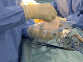 França pode proibir próteses mamárias relacionadas a câncer raro