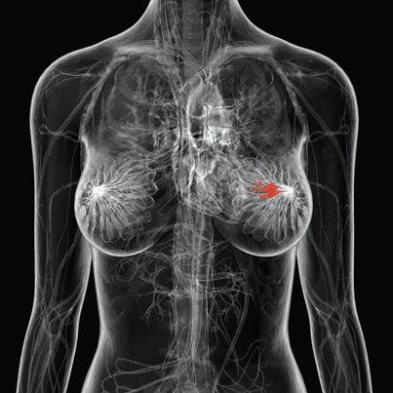 Estudo revela desconhecimento entre mulheres com câncer